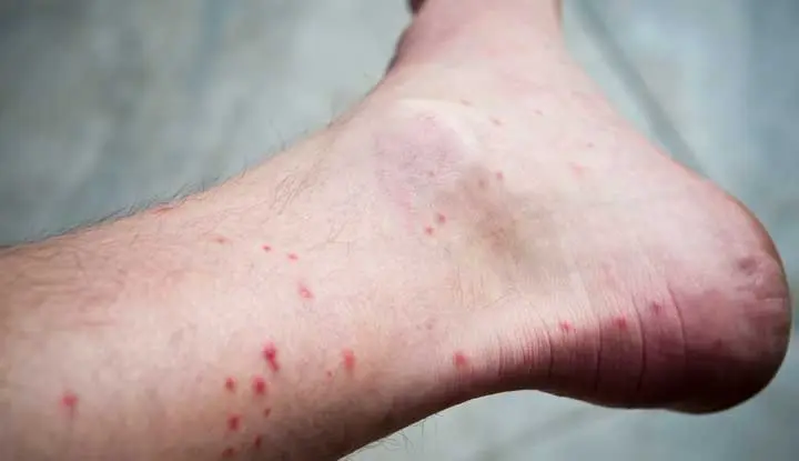 red fleas bites on the lower leg
