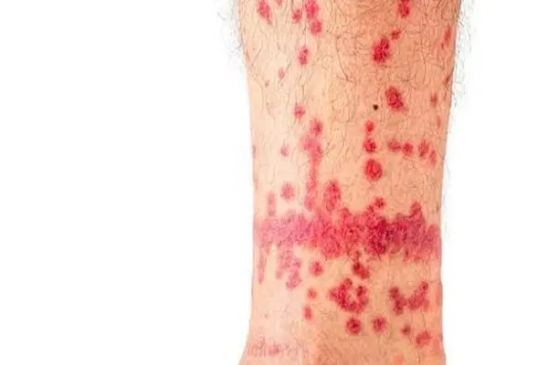 Flea bites on lower legs and ankles