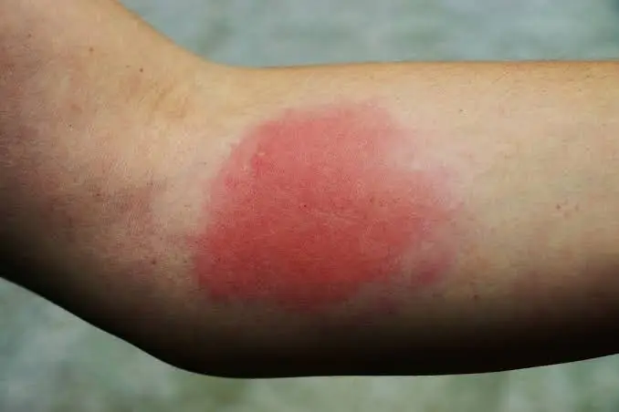 Large swelling from a wasp sting on an arm