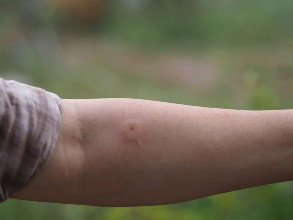 Normal red mark from a wasp sting