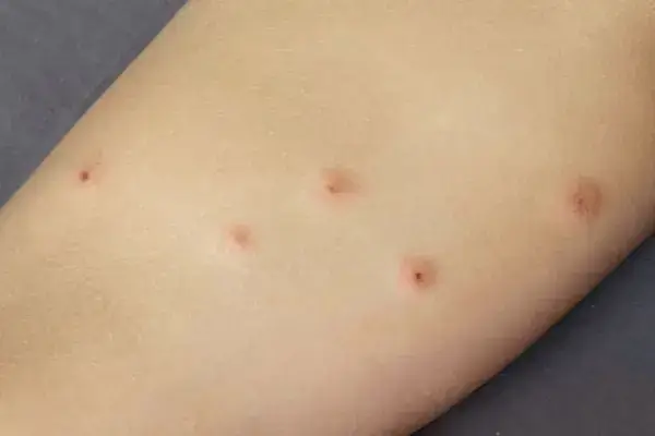Red bite marks on an arm, the kind left by bed bugs or fleas