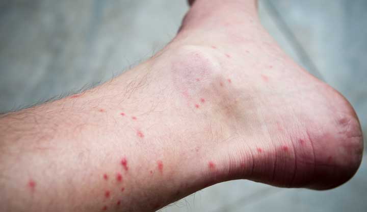 red fleas bites on the lower leg